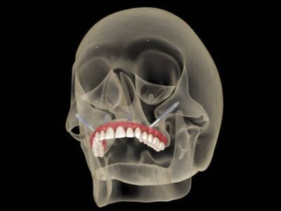 Advantages of Choosing Dental Implants Royal Dental Clinics Dental Implants zygomatic dental implants in Mumbai