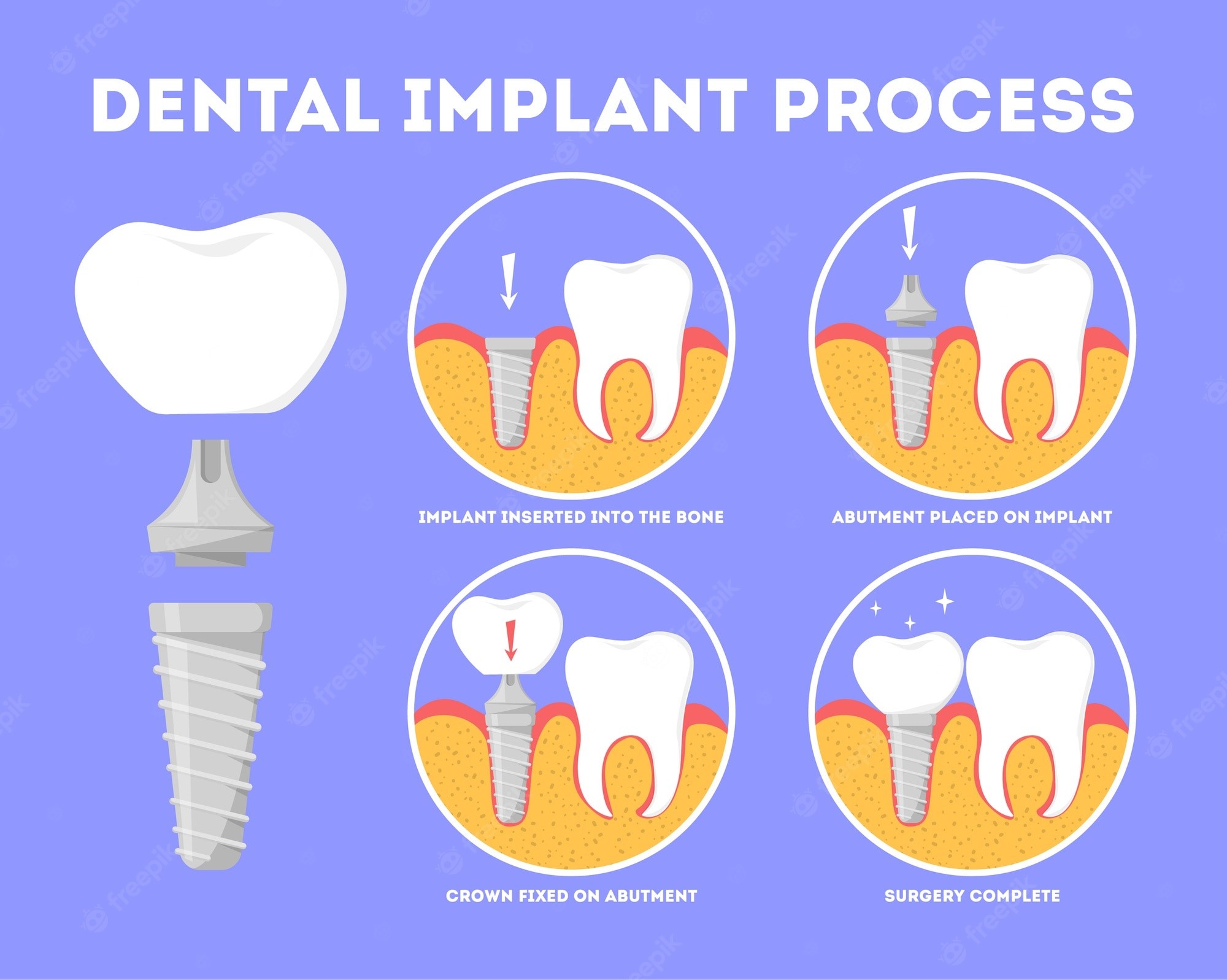 Dental Implant Procedure What To Expect Royal Dental Clinics Blog 