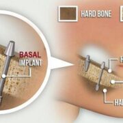 basal vs conventional implants