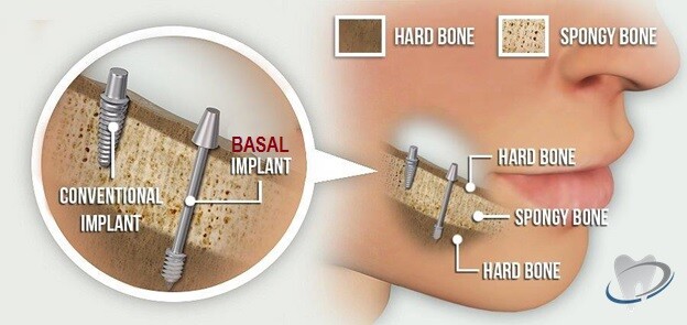 basal vs conventional implants