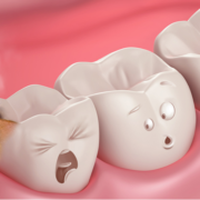 tooth decay cavities