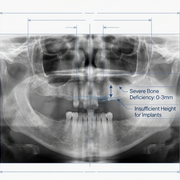 Have I Got Enough Bone for Tooth Implants? Royal Dental Clinics Zygoma Bone Loss in Sinus - Bone for Tooth Implants