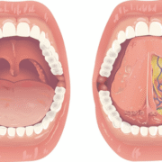 Burning Mouth Syndrome After Radiation Royal Dental Clinics Burning Mouth Syndrome After Radiation