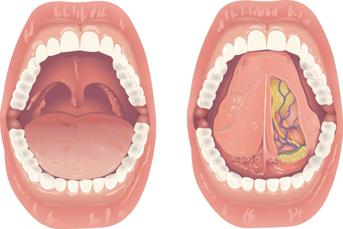 Burning Mouth Syndrome After Radiation Royal Dental Clinics Burning Mouth Syndrome After Radiation