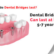 Dental Bridges Treatment