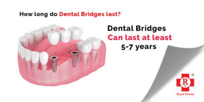 Dental Bridges Treatment