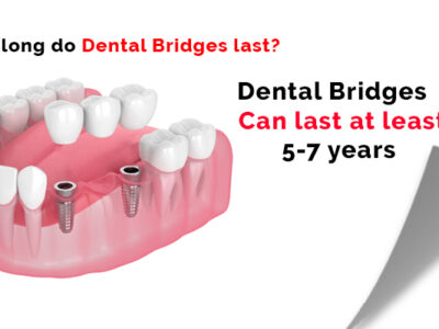 Dental Bridges Treatment