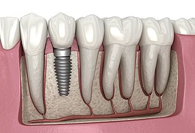dental implants vs natural teeth