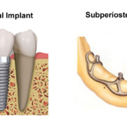 endosteal dental implants
