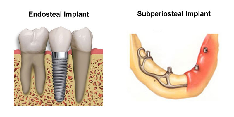 endosteal dental implants with teeth
