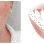 Fixed Teeth in Reduced Mouth Opening