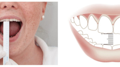 Fixed Teeth in Reduced Mouth Opening
