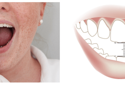 Fixed Teeth in Reduced Mouth Opening