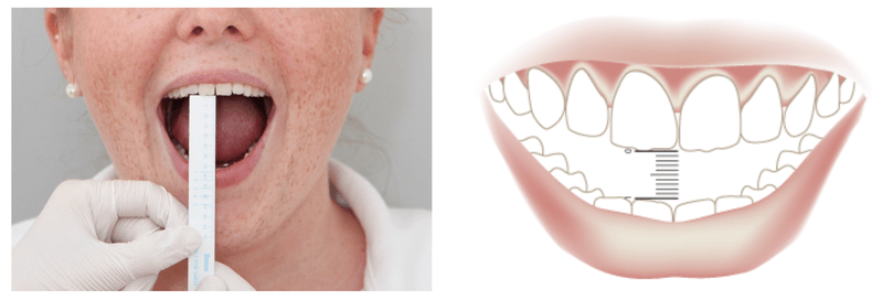 Fixed Teeth in Reduced Mouth Opening Royal Dental Clinics Fixed Teeth in Reduced Mouth Opening