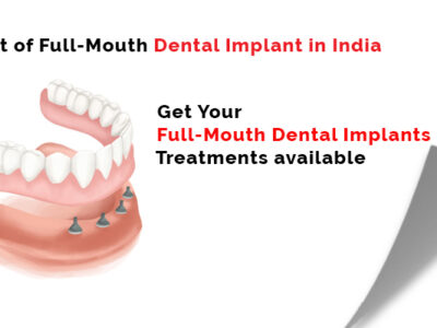 Full mouth Dental Implant in One Day