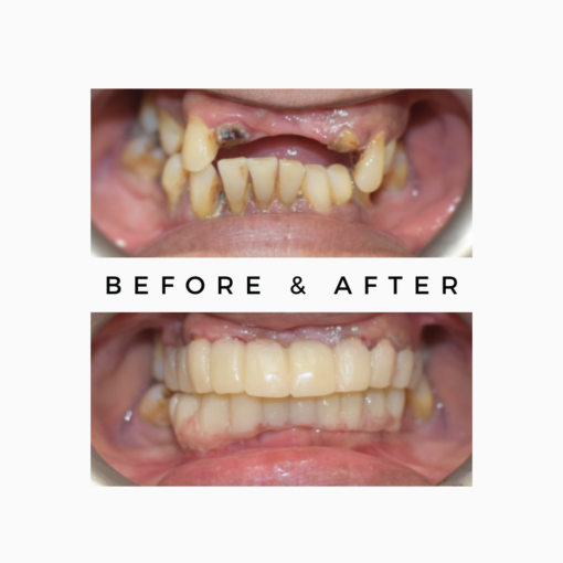 How is an Implant attached to the Crown? Royal Dental Clinics Multiple Front Missing Teeth