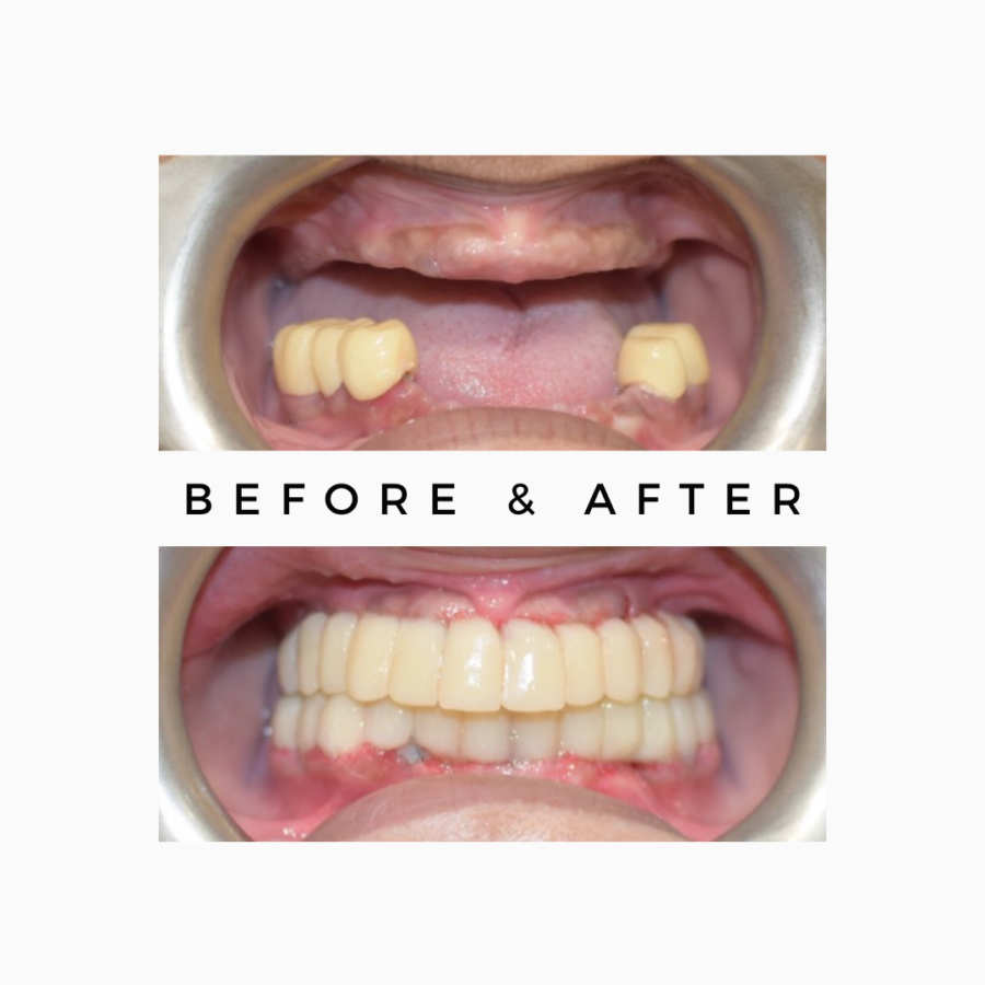 Upper Lower Teeth Replacement Options