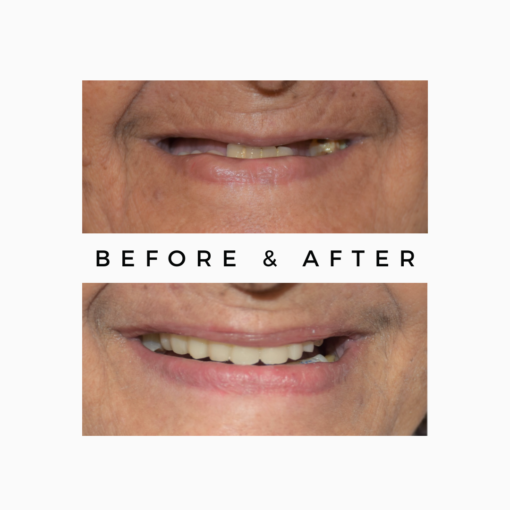 Failed Dental Implants Rehabilitation