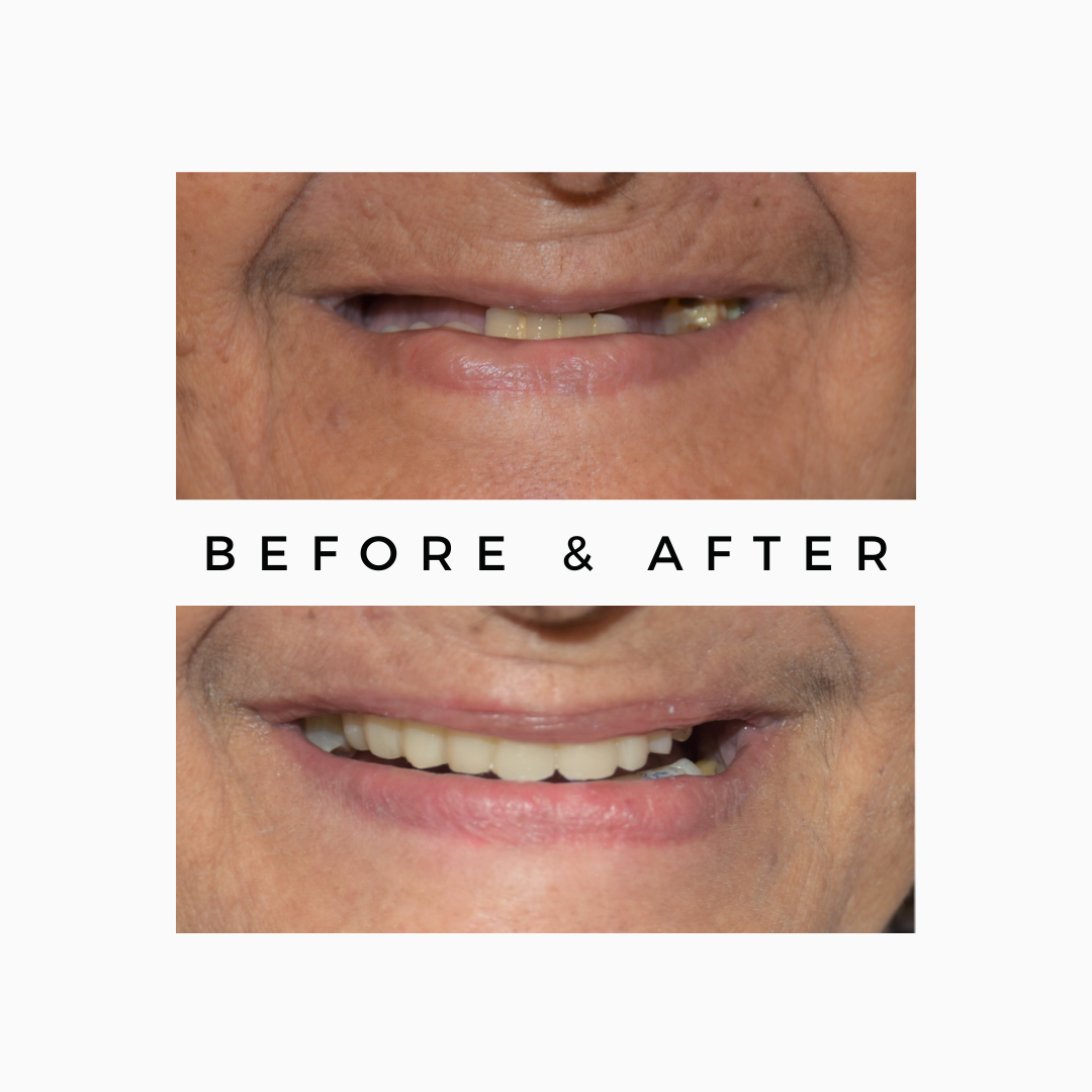Full Mouth Dental Implants Royal Dental Clinics Failed Dental Implants Rehabilitation