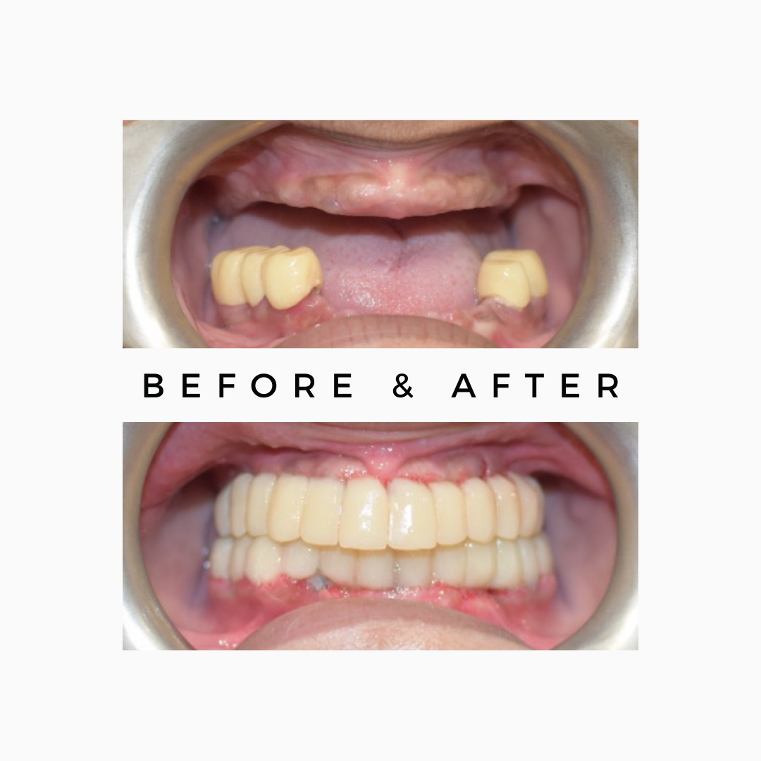 Full Mouth Dental Implants Royal Dental Clinics Upper Lower Teeth Replacement Options