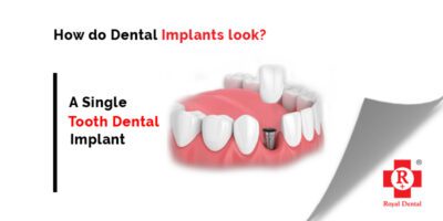 Dental Implant in Mumbai