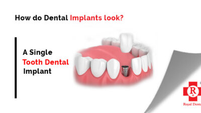 Dental Implant in Mumbai