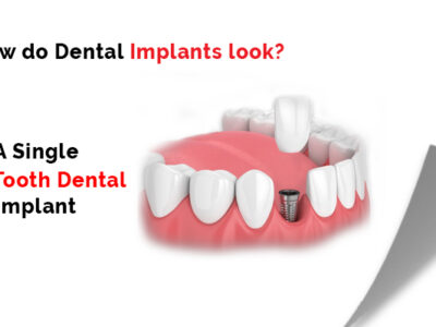 Dental Implant in Mumbai