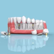 dental implants in Mumbai