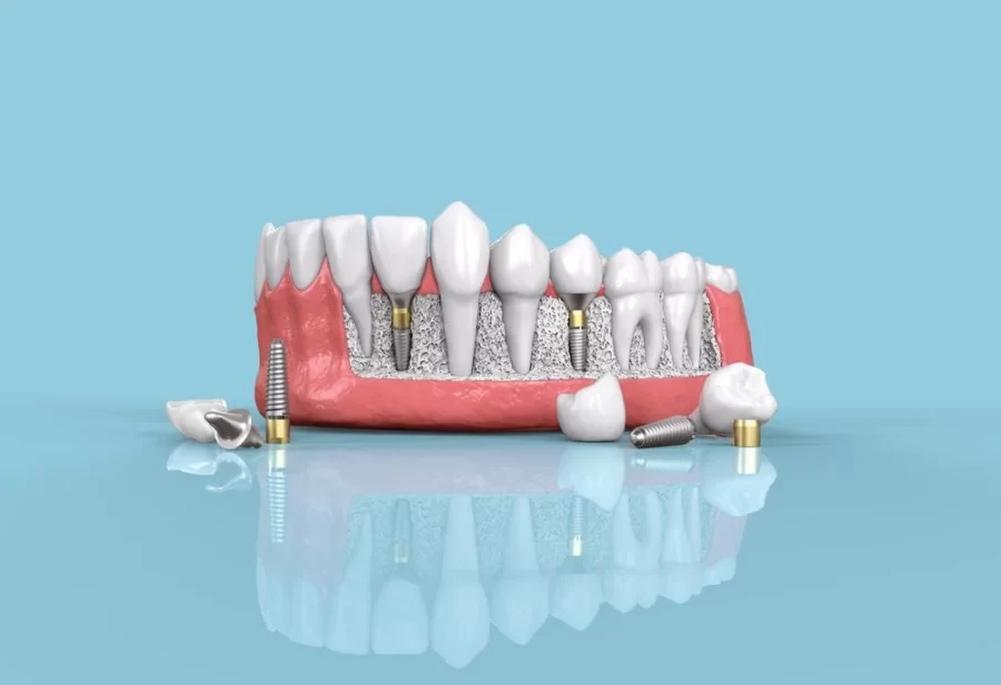 dental-implants-in-Mumbai