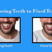 Fixed teeth no missing teeth