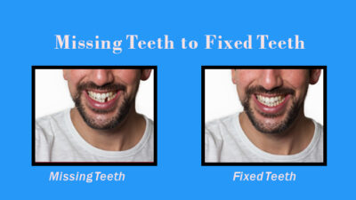 Fixed teeth no missing teeth