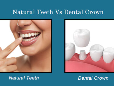 Natural teeth vs dental crown