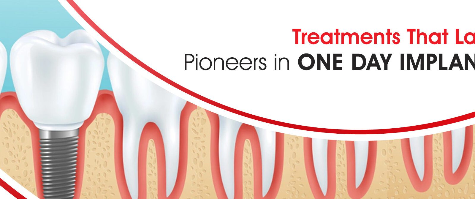 One-Day Dental Implants: Same-Day Fixed Teeth Royal Dental Clinics full mouth dental implants