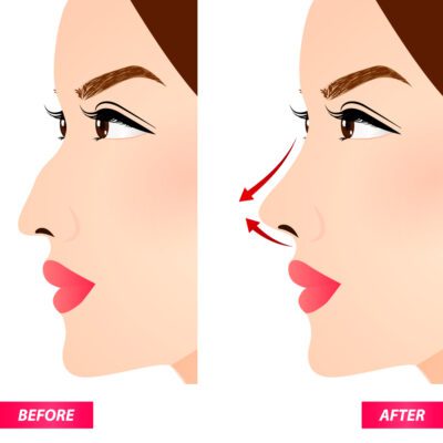 How much does a Nose Job Cost in India? Royal Dental Clinics Nose Implants on face
