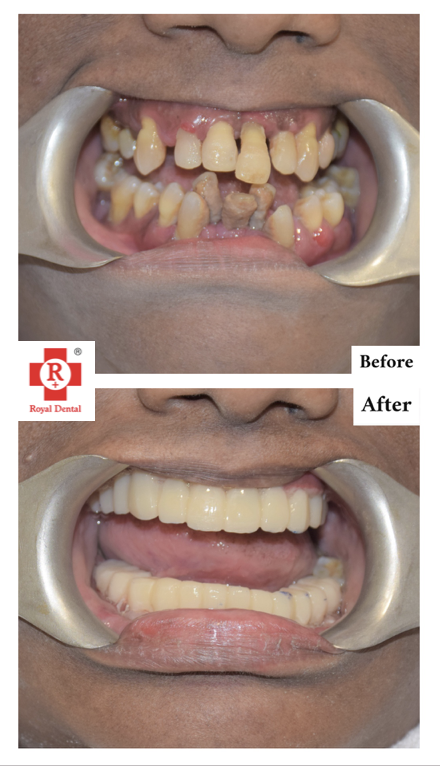 missing teeth with SAPTeeth