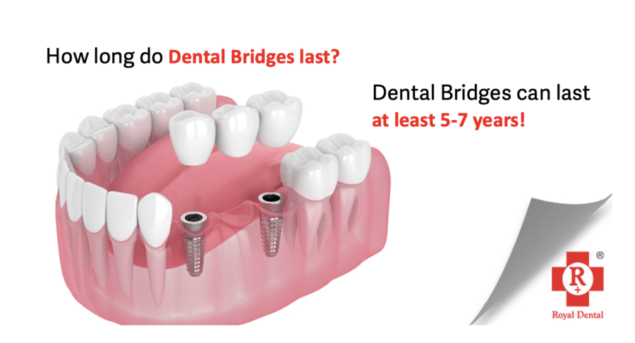 How Long Does a Dental Bridge Last? Lifespan and Care Royal Dental Clinics dental Bridge last