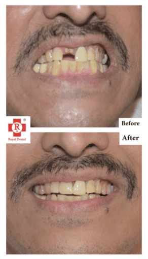 Single Missing Tooth