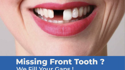 missing teeth dental implants