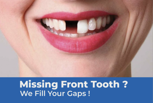 missing teeth dental implants