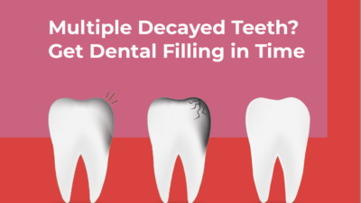 Decayed Teeth Filling