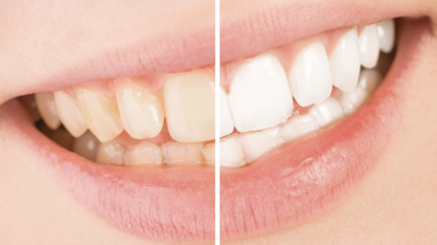 Before After Teeth Yellow