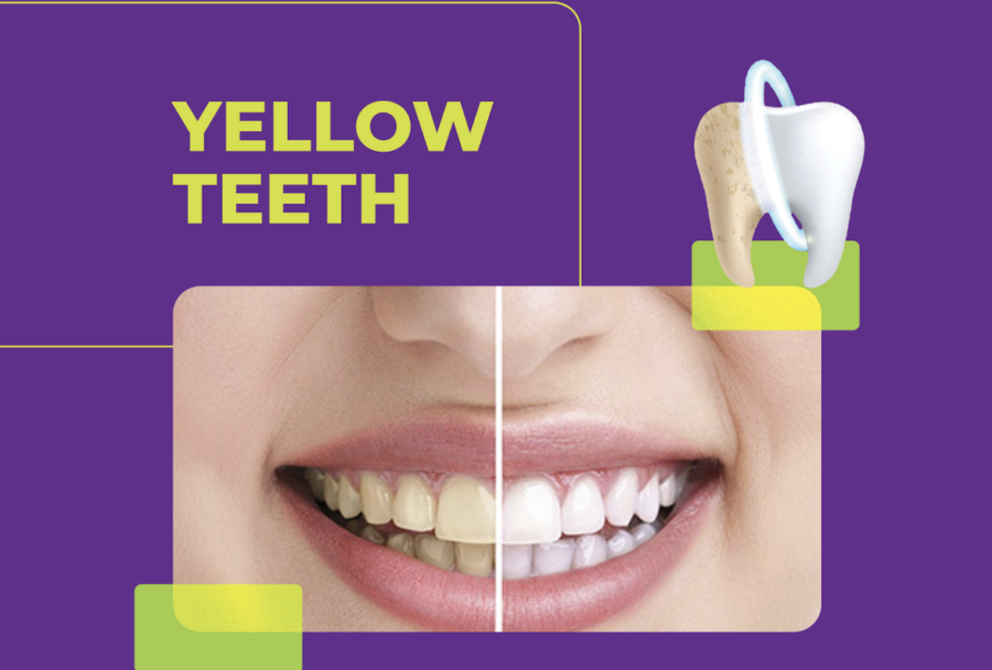 Yellow Teeth Whiten