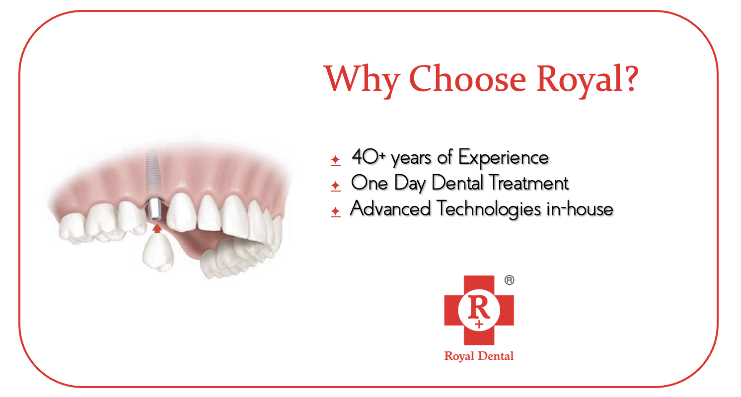 What can you do for Upper Missing Teeth? - Royal Dental Clinics Blog