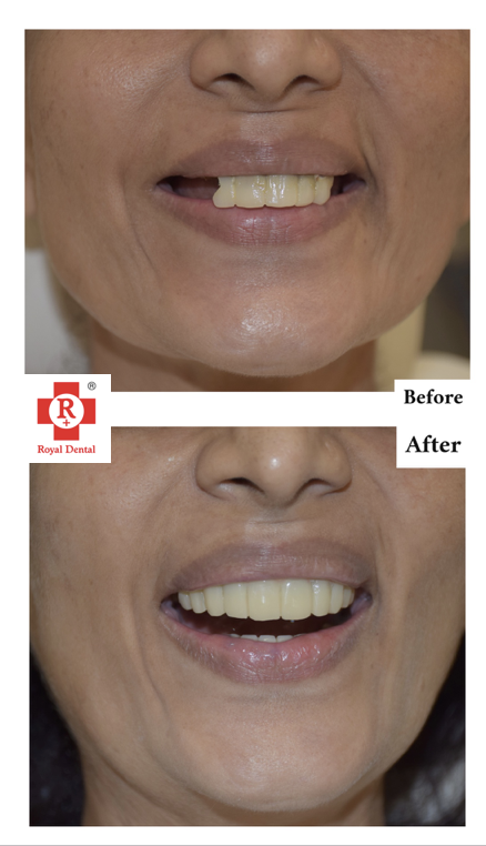 Patient Smile with Implants