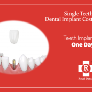 Single teeth dental implant