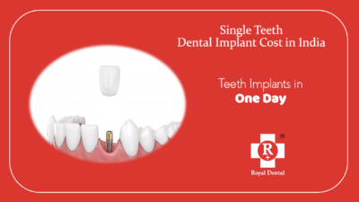 Single teeth dental implant