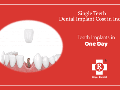 Single teeth dental implant