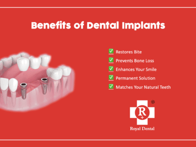 dental implants