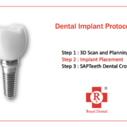 dental implant protocols