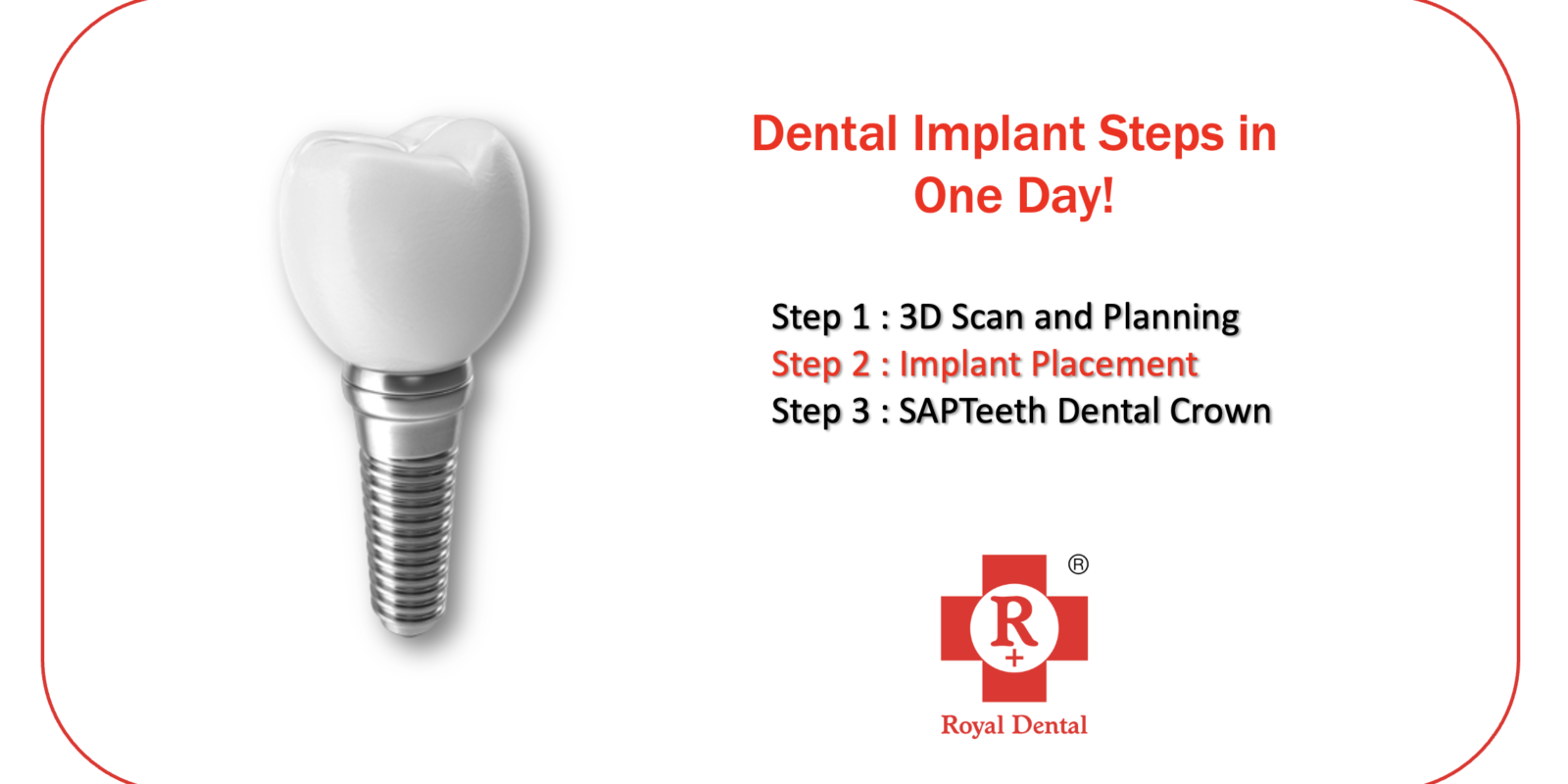 dental implant in one day